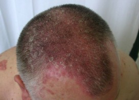 ekcémás fejbőr hajfestés pikkelysömör kezelése hagymával