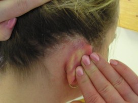 Ekcéma, seborrhoeás dermatitis és a hajhullás