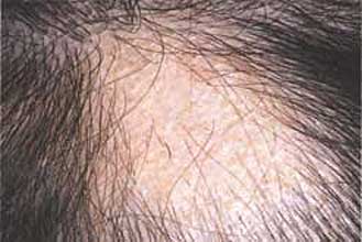 A seborrheás dermatitisz okozta hajhullás és kezelése