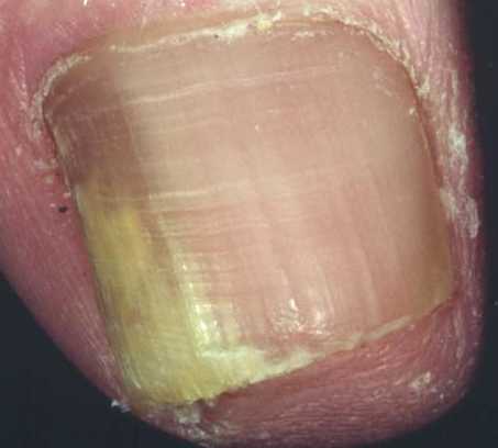 nail gombusz, mint a kezelés hogyan kell kezelni a köröm gomba által fehérítő