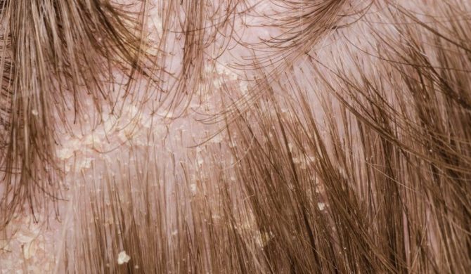 Eucerin®: Fejbőr- és hajproblémák | Az érzékeny fejbőrről
